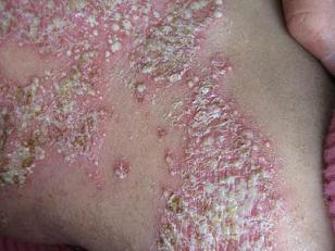 牛皮癣的治疗要注意什么