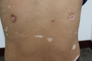 如何治愈白癜风