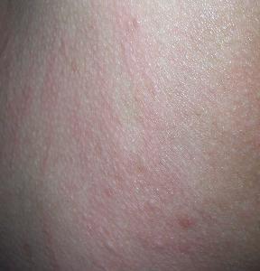 神经性皮炎患者的饮食禁忌有哪些