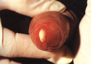 淋病与支原体有什么区别