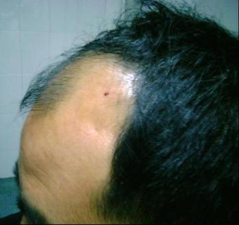 斑秃的症状表现