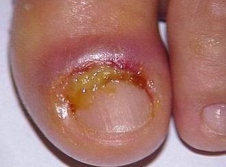 化脓性甲沟炎.jpg