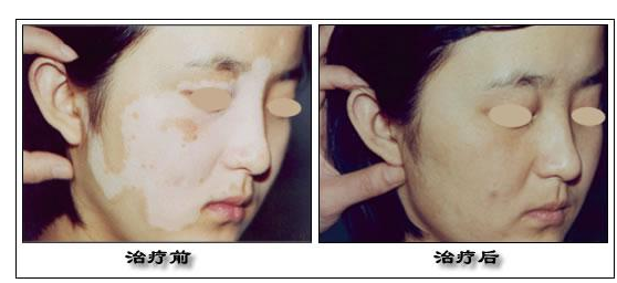 白癜风治疗前后对比