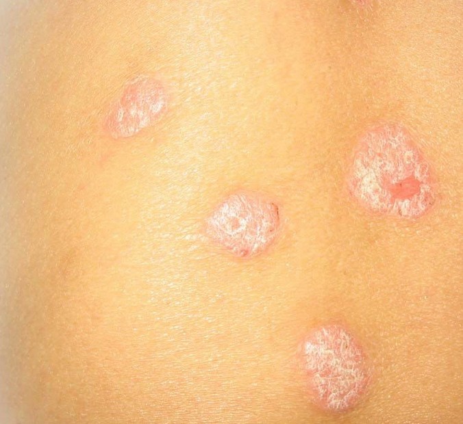 牛皮癣怎么治疗最好