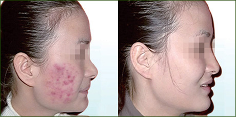 18岁高中学生在我院治愈痘痘的案例