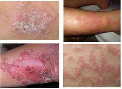 皮肤瘙痒治疗前后的对比图