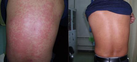 荨麻疹的治疗前后的对比图