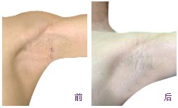 腋臭手术前后疤痕