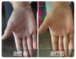 顽固性手癣终于治疗好了
