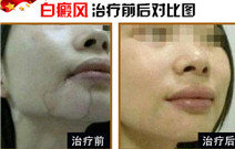 白癜风