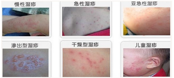 手部湿疹症状