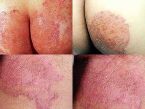 南昌中山皮肤病医院体癣治疗前后对比