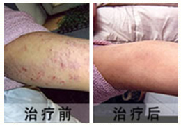 湿疹康复案例
