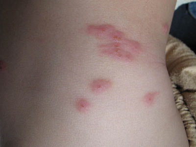 丘疹性荨麻疹综述