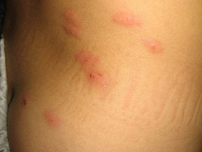 丘疹性荨麻疹综述