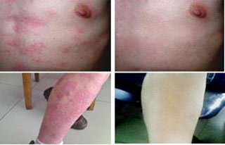 荨麻疹最好的治疗方法