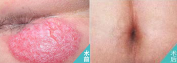 湿疹康复案例