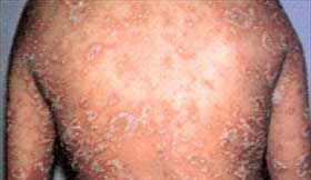 治疗牛皮癣去哪里好